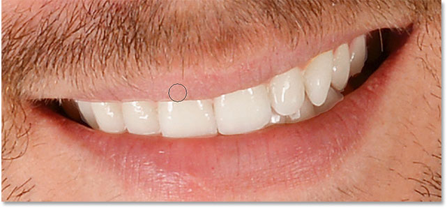 whiten teeth cleanup upper lip