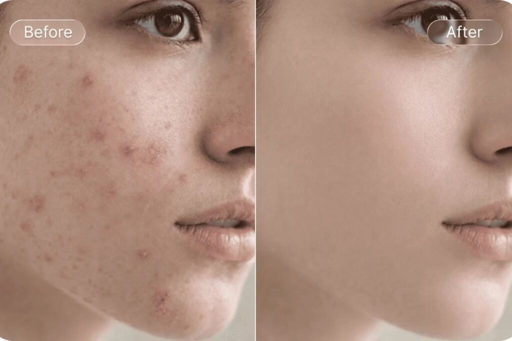xóa mụn trên ảnh