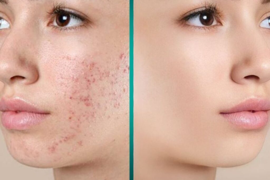 xóa mụn trên ảnh