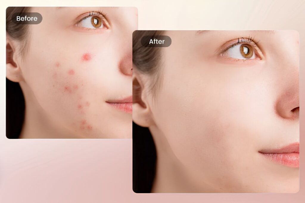 xóa mụn trên ảnh